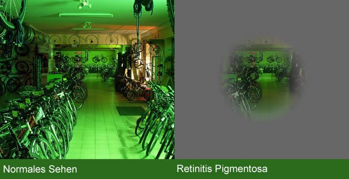 Retinitis Pigmentosa